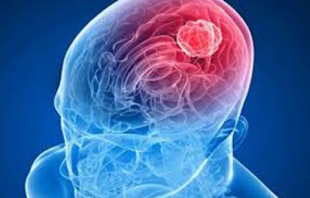 Beyin Tümörünün Habercisi Olabilir!