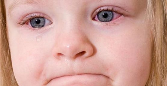 Çocukların Göz Sulanmasına Dikkat!
