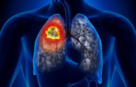 En Sık Görülen Kanser Türü 'Akciğer'!