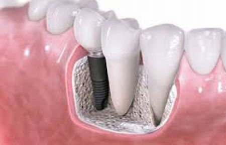 İmplant Tedavisinde Devrim Gibi Yenilik!