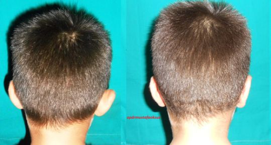 'Kepçe Kulak' Sorunu Çözüme Kavuşuyor!