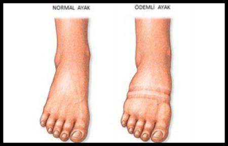 Şişlikler Lenfödem Habercisi Olabilir