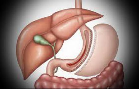 Tüp Mide Operasyonu Tavsiyeleri!